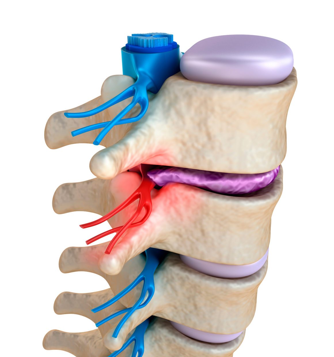 Pinched Nerve Symptoms Treatments MN Spine Institute