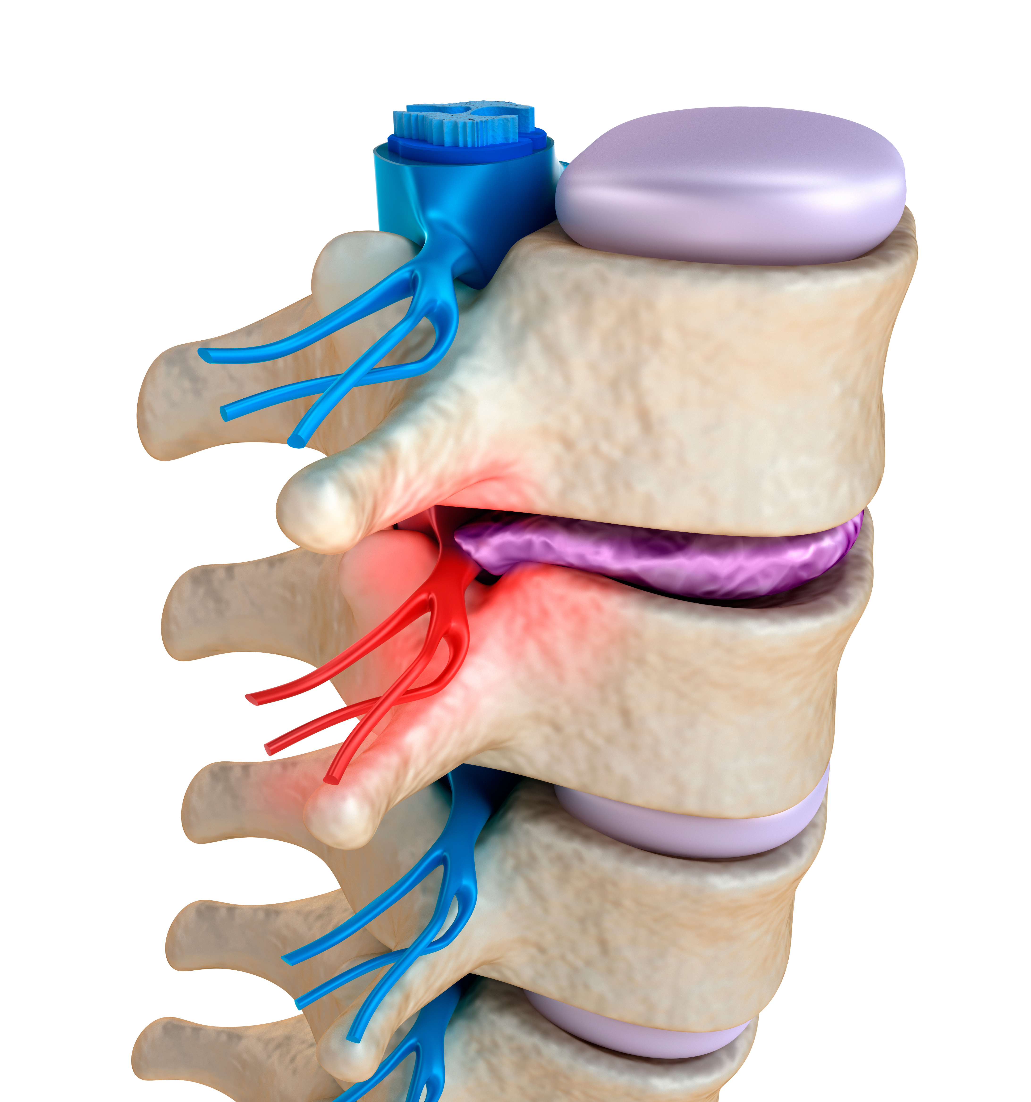 Pinched Nerve Symptoms and Treatments - Spine Institute