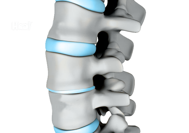 Degenerative disc disease is a condition in which natural, age-related wear-and-tear on a disc and spine causes possible pain, instability, and other symptoms. 