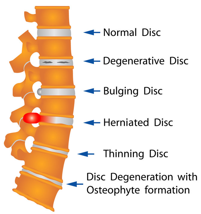 Disc Replacement