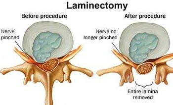 A laminectomy is a minimally invasive procedure can also treat foraminal stenosis.
