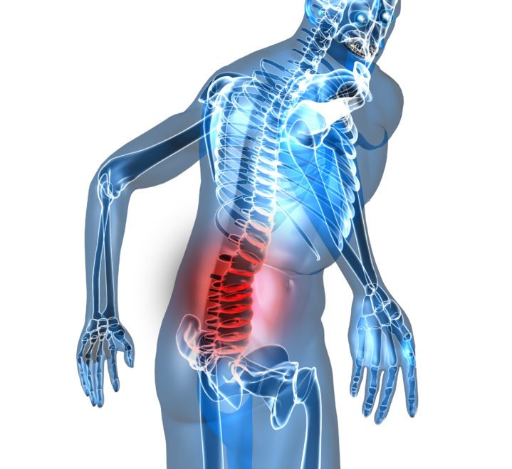 Lumbar Stenosis