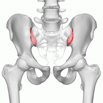 Sacroiliac joint syndrome occurs when the sacroiliac ligaments are damaged or torn due to age, strain, an accident, or hypermobility in the ligamentous structures.