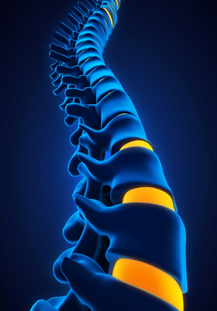 Spinal Stenosis