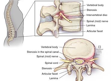 Spinal Stenosis is the narrowing of one or more spaces within your spinal canal.