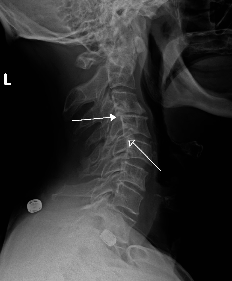 Bone Spurs Minnesota Spine Institute