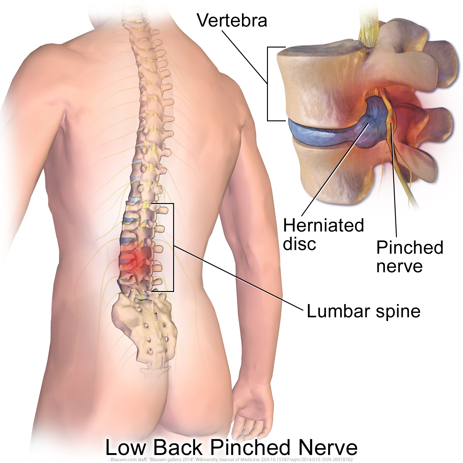 pinched nerve - minnesota spine institute