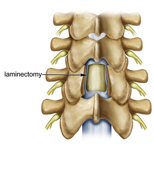 Laminectomy Laminotomy