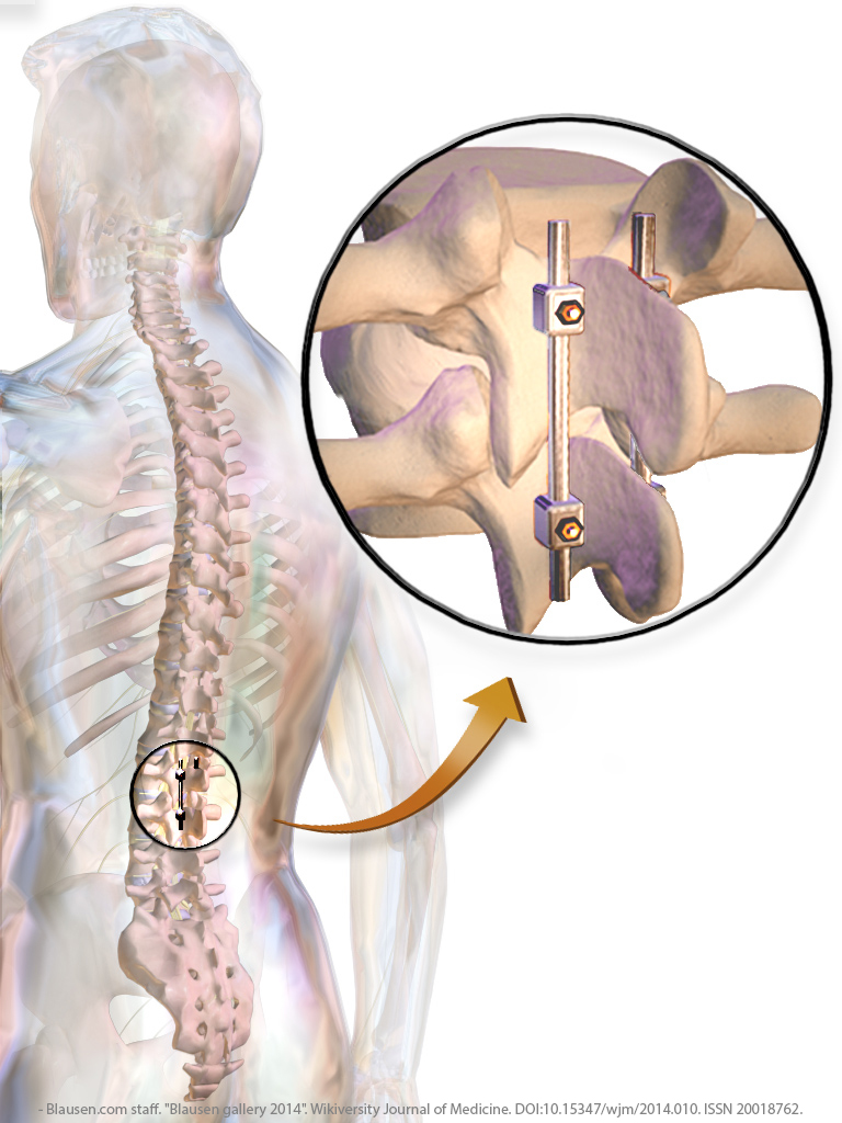 Lumbar spinal arthrodesis surgery